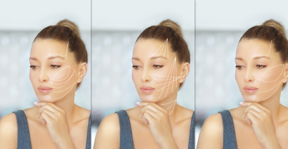 thread lift patient thread lift patient